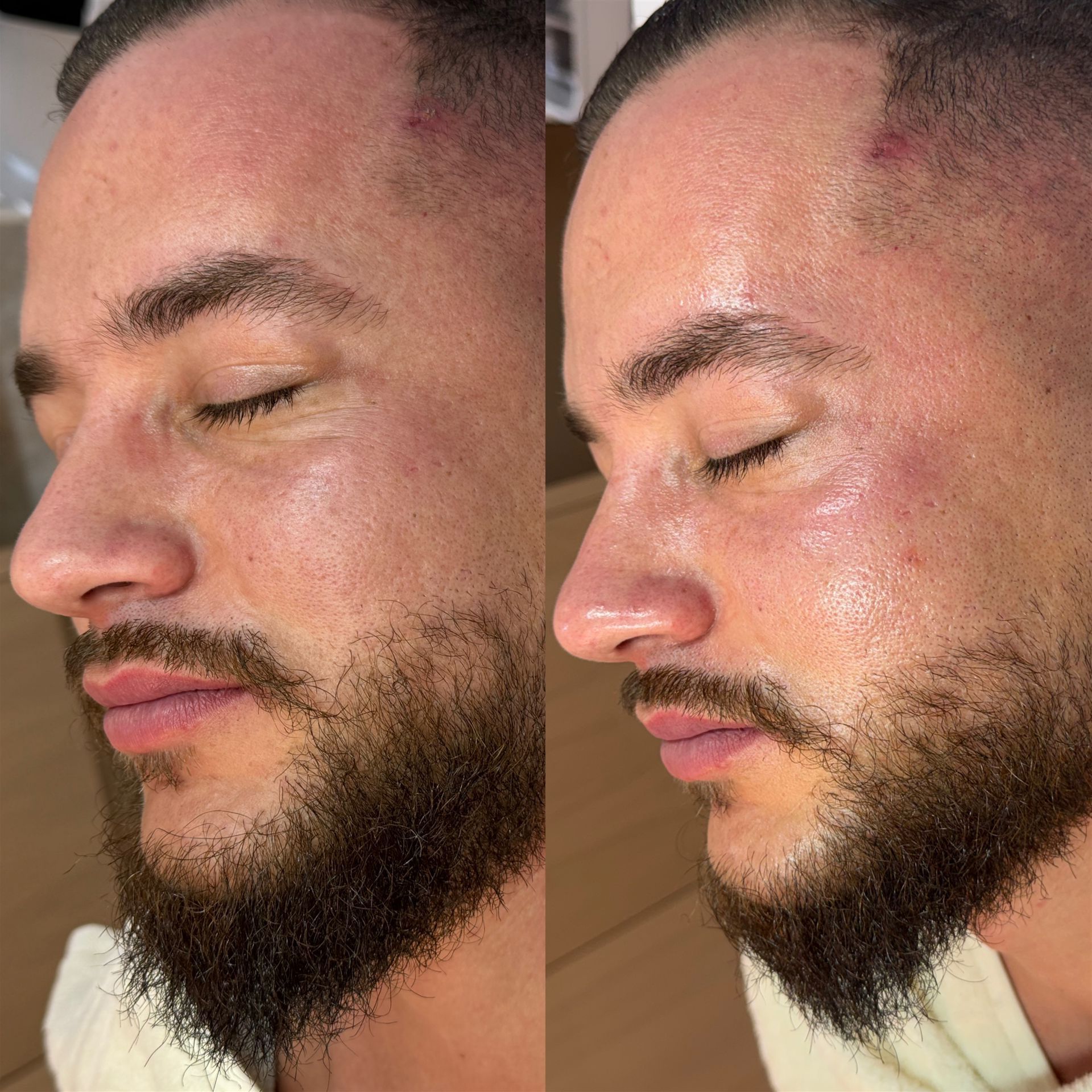 HydraFacial Vorher Nachher: Hautbild mit Glow