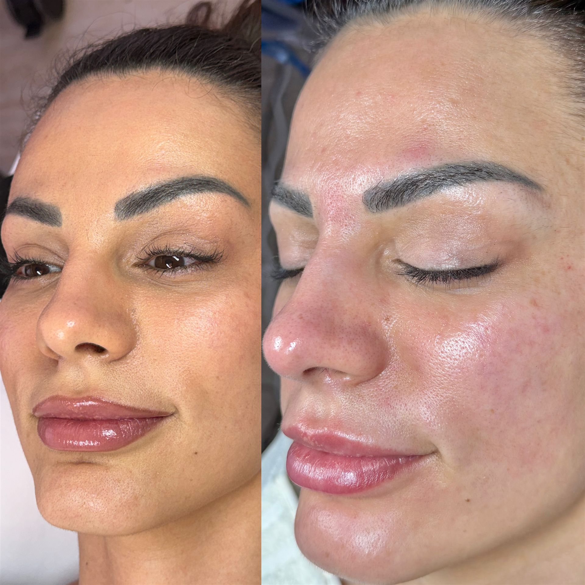 HydraFacial Vorher Nachher, ebenmäßigeres Hautbild