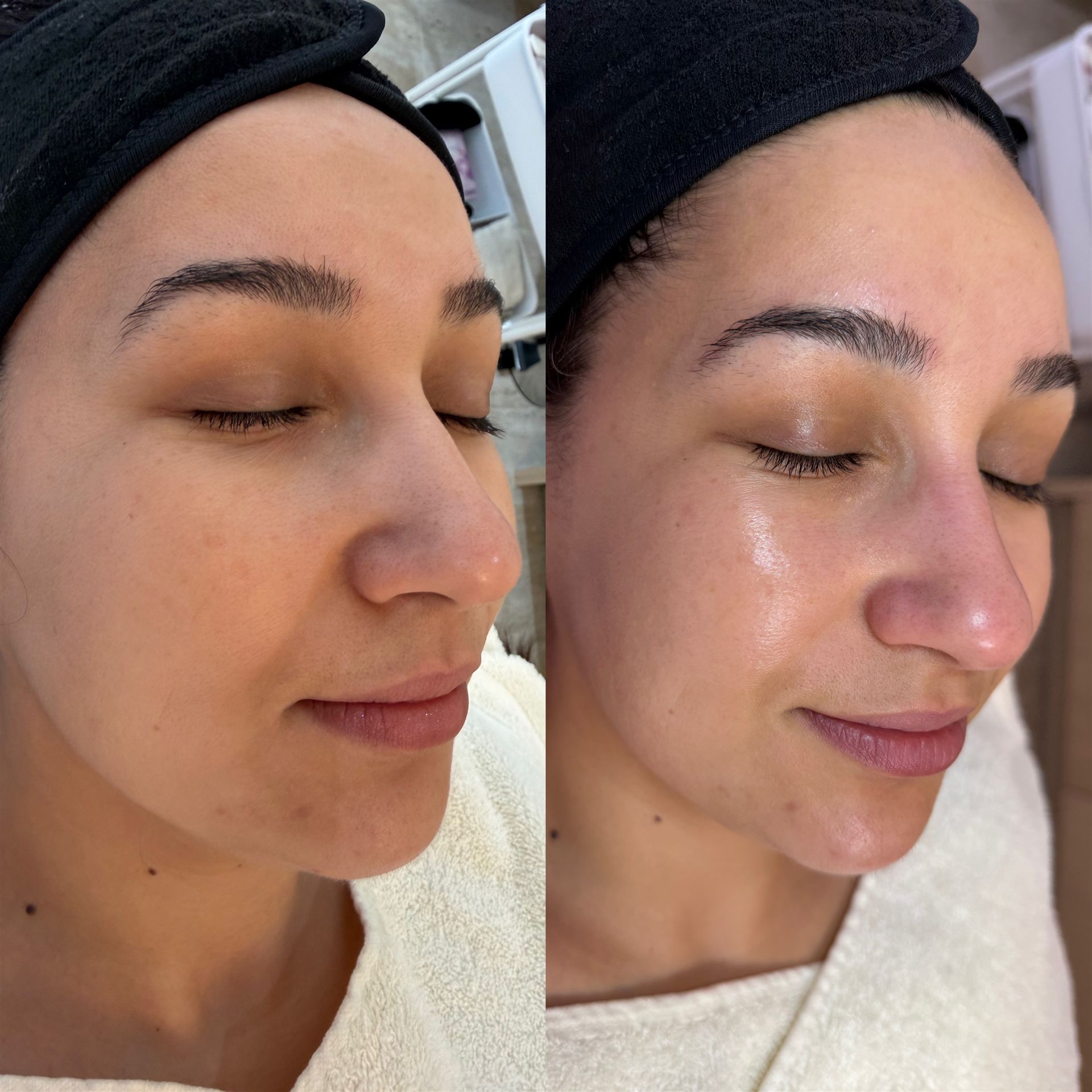 HydraFacial Vorher Nachher, frische, strahlende Haut